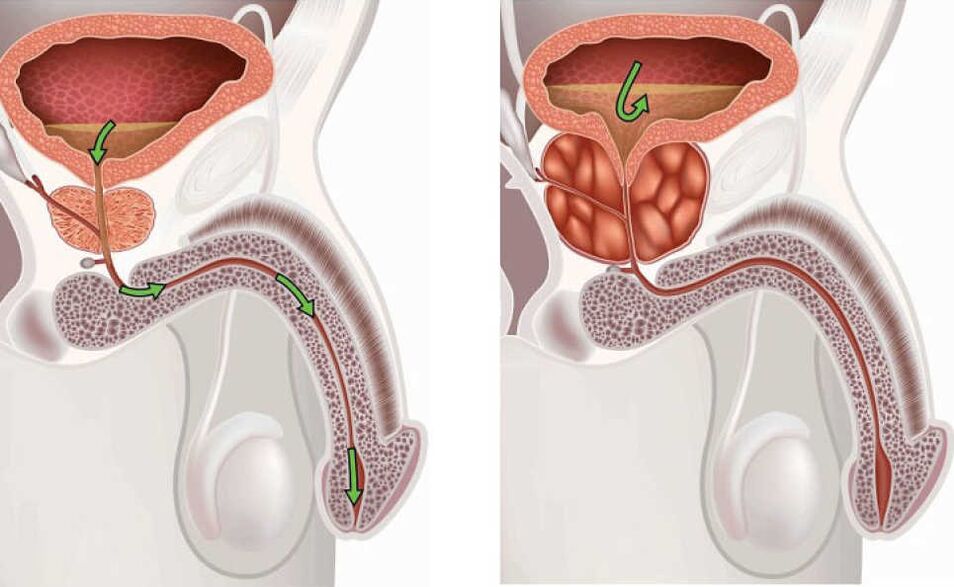 Inflammation of the prostate gland