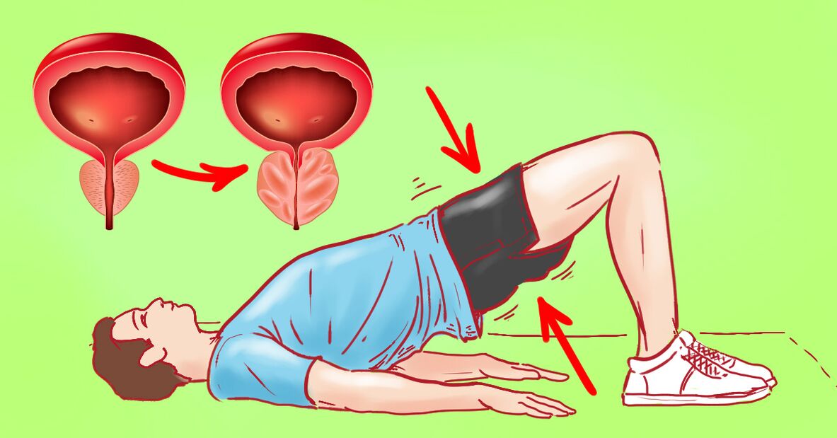 Therapeutic exercises of chronic prostatitis