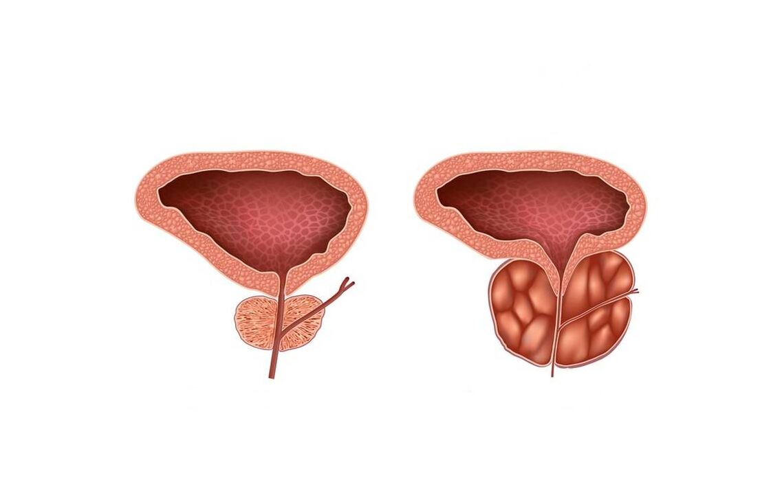 Symptoms of prostatitis in men