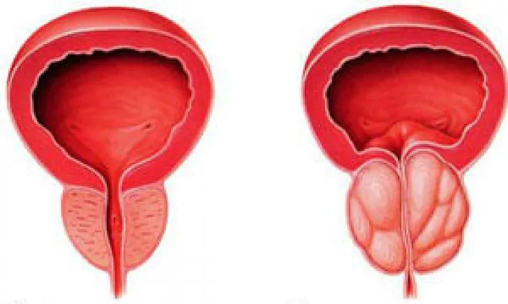 Normal prostate (left) and chronic inflammatory prostatitis (right)