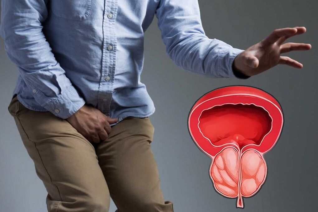 Acute prostate gland in men